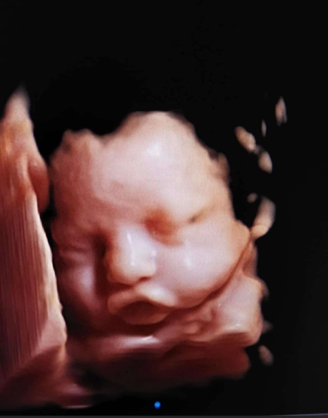 Unlike traditional 2D ultrasound, which produces flat, two-dimensional images, 3D ultrasound allows for a more complete and accurate view of the area being examined.