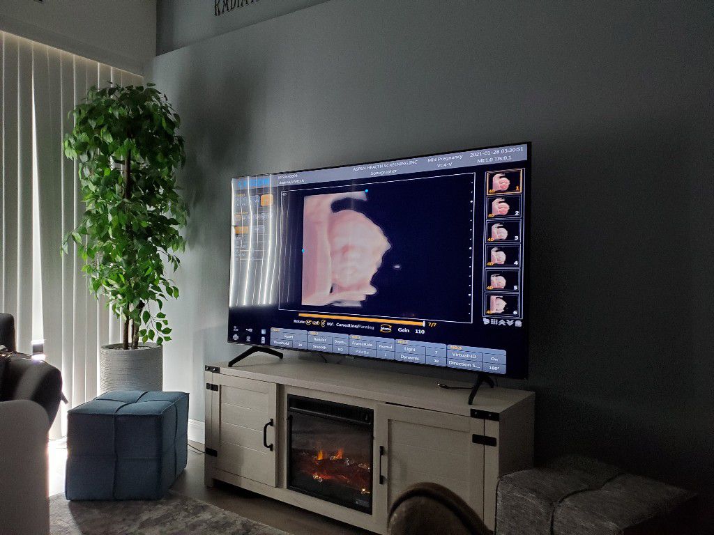  The ultrasound machine consists of several essential components, including a transducer, a computer, and a display screen. 